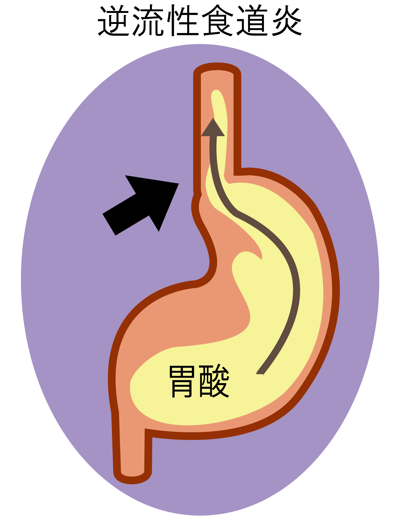 逆流性食道炎