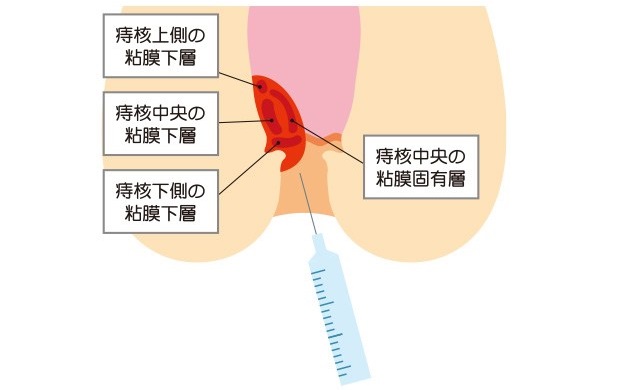 ALTA療法（ジオン注射）