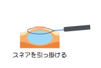 大腸ポリープ切除の流れ